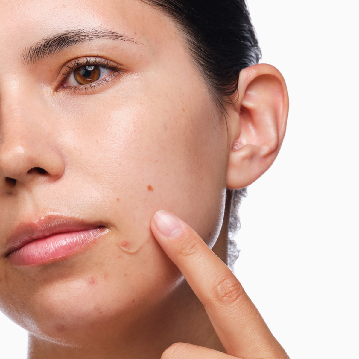 the-acne-set-l9 rdn-the-acne-set-application.png