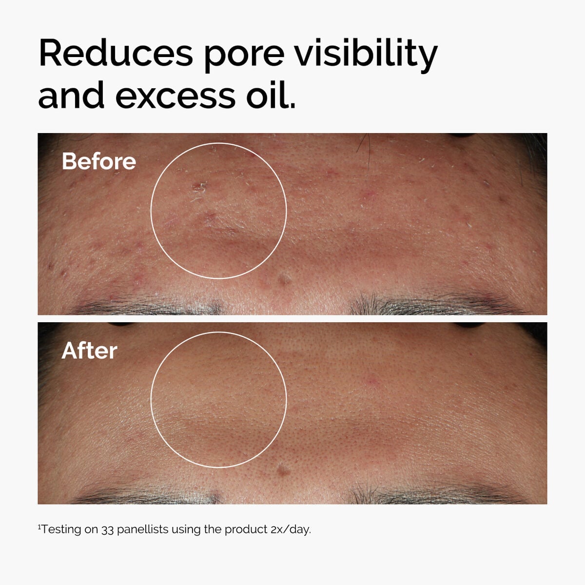 niacinamide-10-zinc-1-f4 ord-niacinamide-zinc-blemish-serum-before-after-pores.jpg
