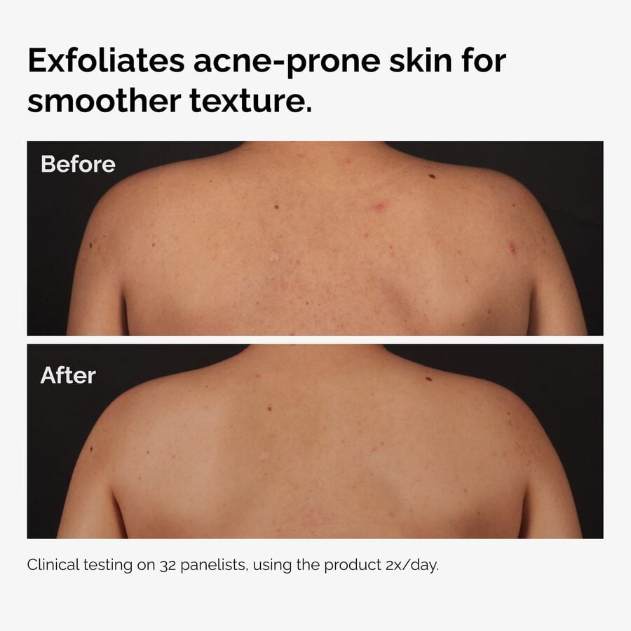 the-body-care-collection-s6 ord-salicylic-acid-body-serum-before-after-graphic-NA.jpg