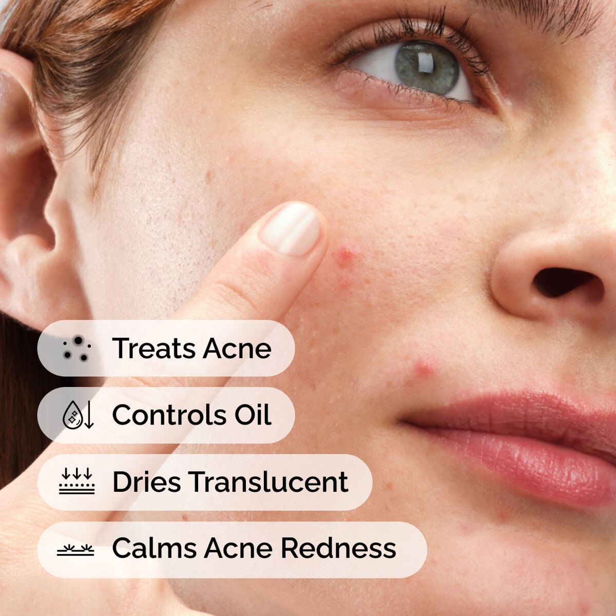 sulfur-10-powder-to-cream-concentrate-z4 ord-sulfur-10pct-powder-to-cream-concentrate-model-application-with-benefits-acne.jpg